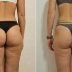LA CELULITIS AFECTA HASTA AL 90 % DE LAS MUJERES: